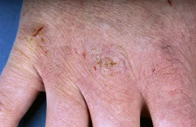 Abb. 5.7: Irritatives Handekzem durch unzureichenden Hautschutz, beeinträchtigt den Infektionsschutz