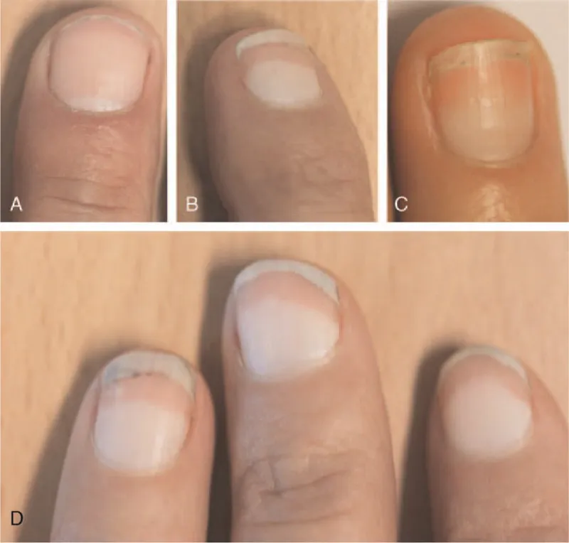 Beispiele für proximale apparente Leukonychie: Terry-Nägel und Lindsay-Nägel