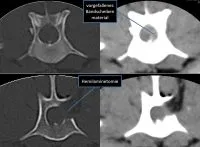 CT-Bild eines Hunde-Rückenmarks mit deutlich sichtbarem Bandscheibenvorfall zwischen den Wirbeln T13 und L1, aufgenommen bei einer 5-jährigen französischen Bulldogge, um die Diagnose bildgebend darzustellen.