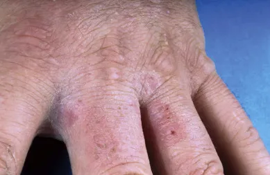 Interdigitales Ekzem: Eine Folge unzureichender Händehygiene im Gesundheitswesen.