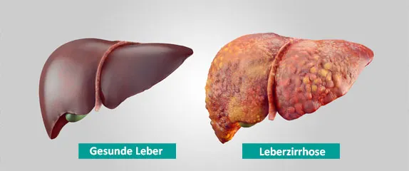 Leberzirrhose