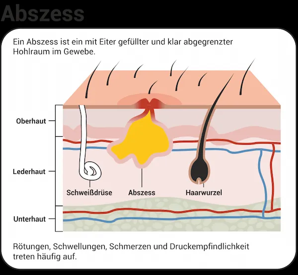 Abszess - ein mit Eiter gefüllter und klar abgegrenzter Hohlraum im Gewebe