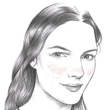 Gesicht einer Frau mit Couperose-Rötungen auf den Wangen, gezeichnete Schwarz-Weiß-Illustration