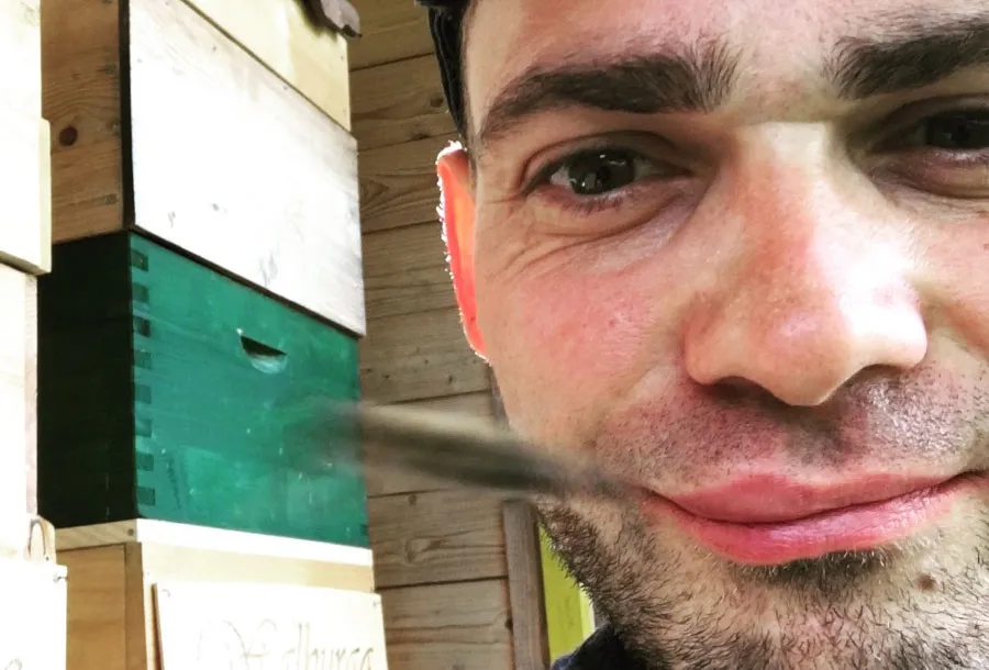 Lippe nach Bienenstich: Ein ungewollter Botulinumtoxin-Effekt