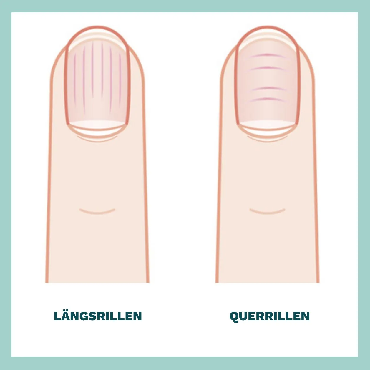 Querrillen auf Fingernägeln, die durch Verletzungen oder als Folge von Krankheiten entstehen können.