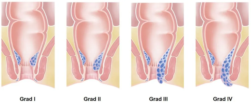 Schematische Darstellung der vier Grade von Hämorrhoiden
