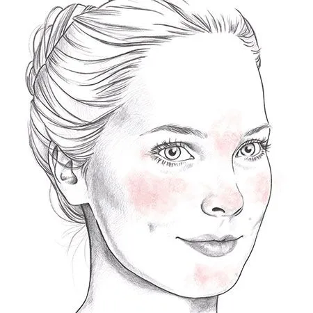 Skizze eines weiblichen Gesichts mit geröteten Hautstellen an Wangen, Nase und Kinn, Blick nach rechts