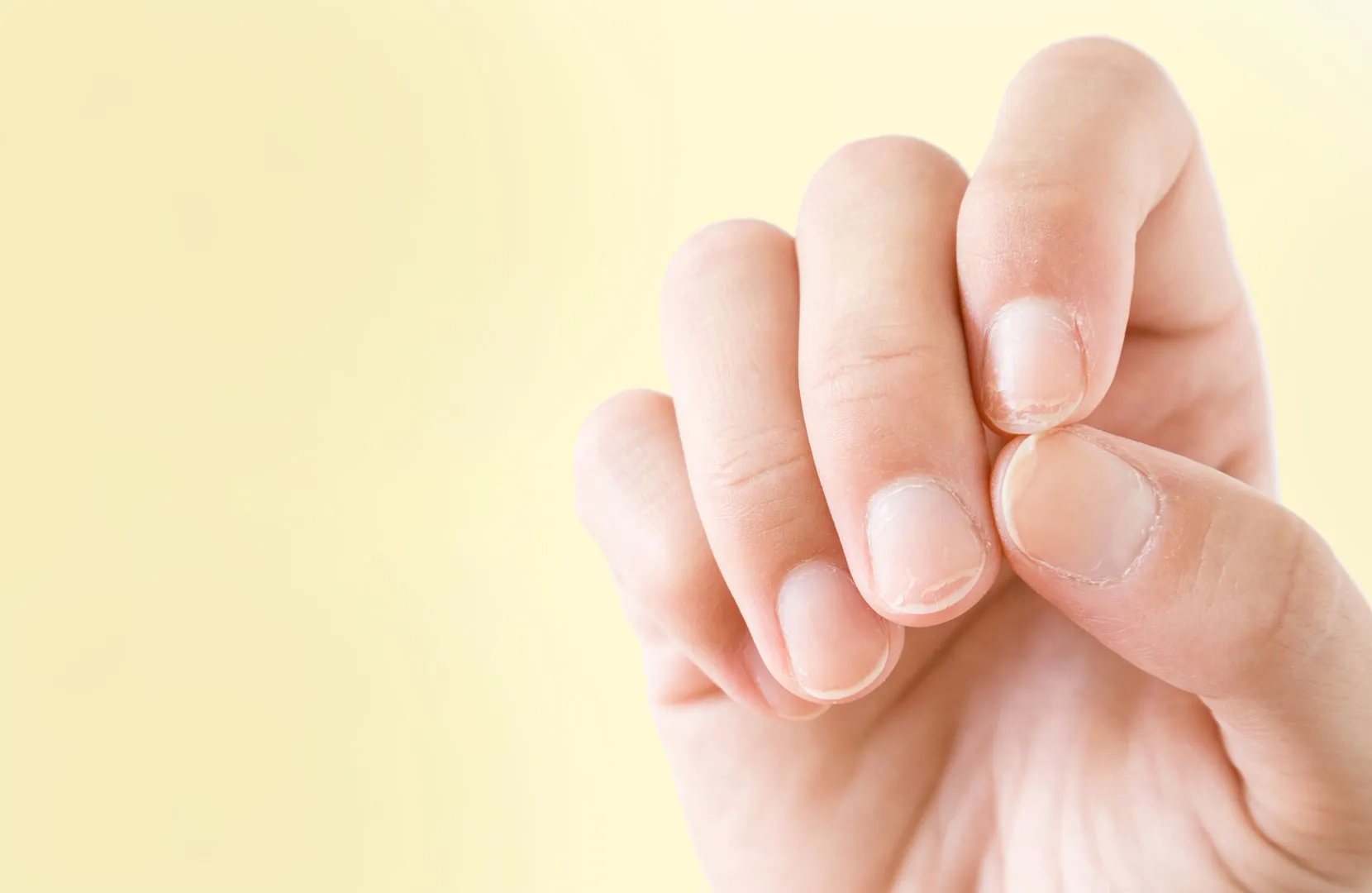 So können die Rillen in den Fingernägeln aussehen. Es wird zwischen Längs- und Querrillen unterschieden, die verschiedene Ursachen haben.