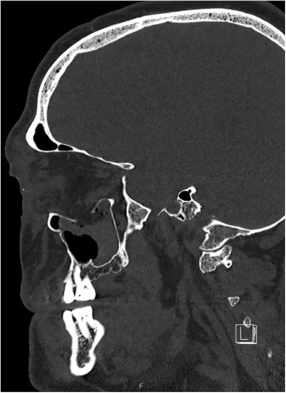CT-Scan einer schweren Orbitalbodenfraktur nach einem Nouss-Treffer