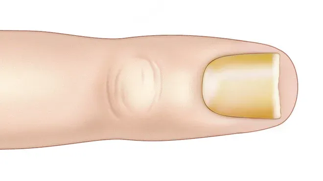 Ein gelb verfärbter Fingernagel