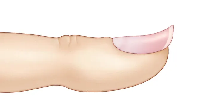 Ein Löffelnagel mit nach innen gesenkter Nagelplatte