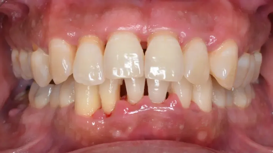 Lockere Zähne im Alter Zahn wackelt