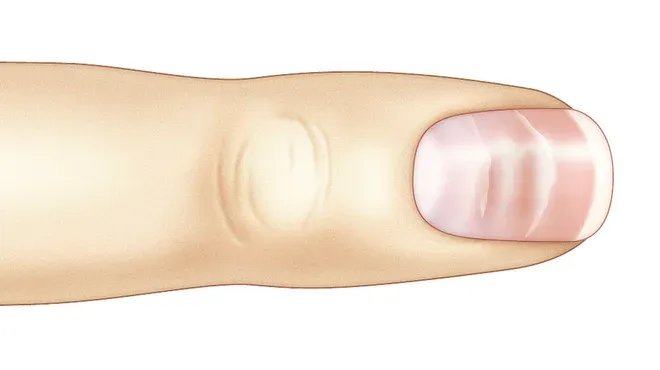 Querrillen auf einem Fingernagel