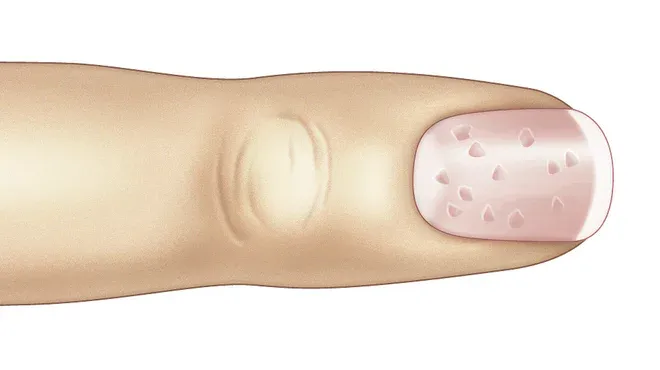 Tüpfelnägel mit kleinen Vertiefungen auf der Nageloberfläche