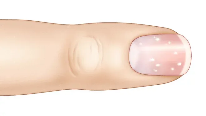 Weiße Flecken auf einem Fingernagel